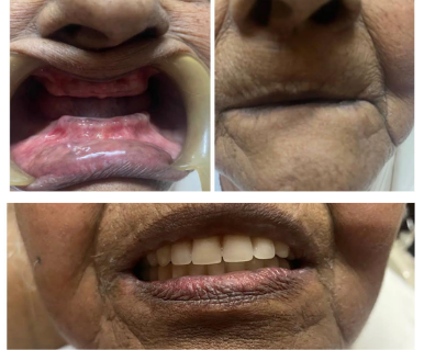 Complete Denture Treatment